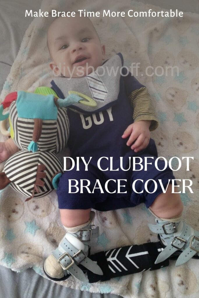 baby wearing a diy clubfoot brace cover